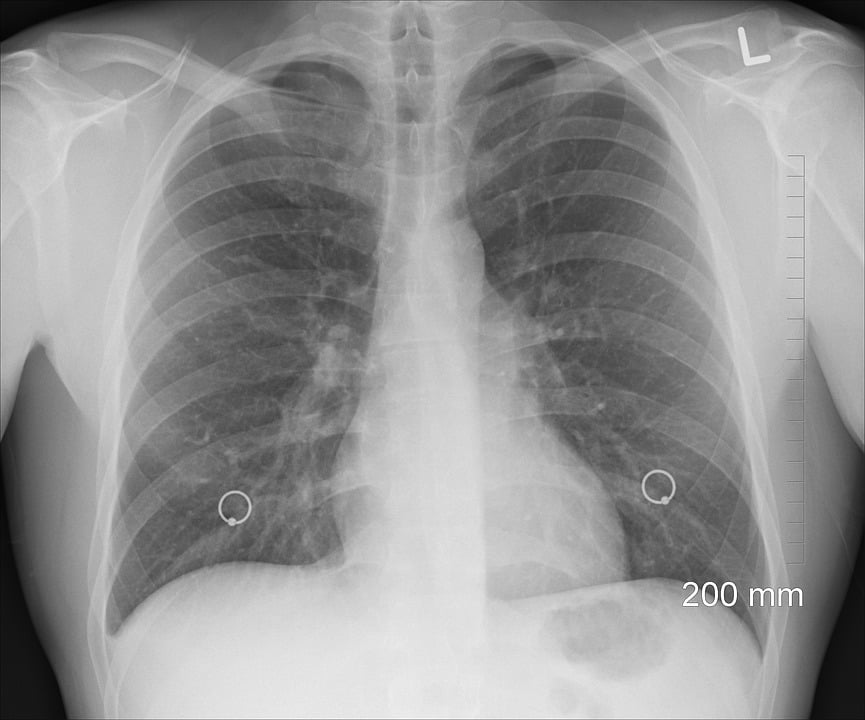 rentgen płuc palacza